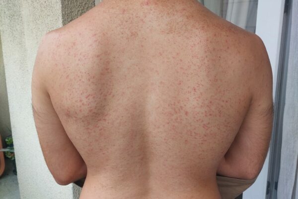 epilation dos hommes boutons soins