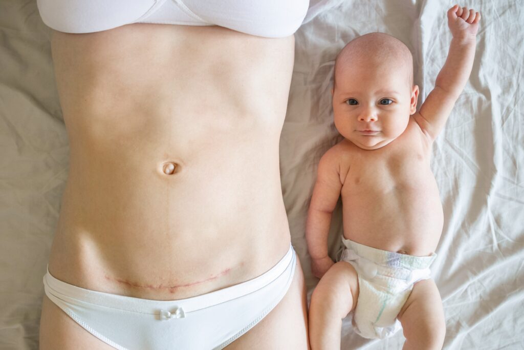 Closeup of woman belly with a scar from a cesarean section and her baby near