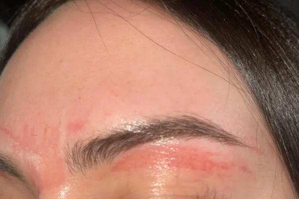 Réaction de la peau brûlée sous les sourcils après épilation à la cire, irritation cutanée, rougeur, soin apaisant post-épilation.