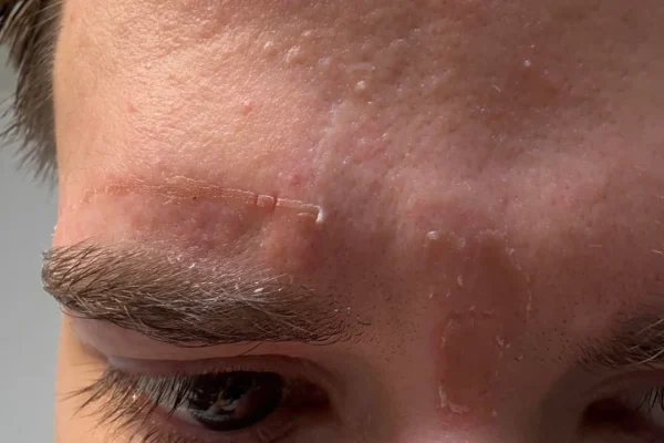 Réaction de la peau avec croûtes et brûlure après une épilation à la cire, irritation cutanée, rougeur, peau abîmée, soin post-épilation.