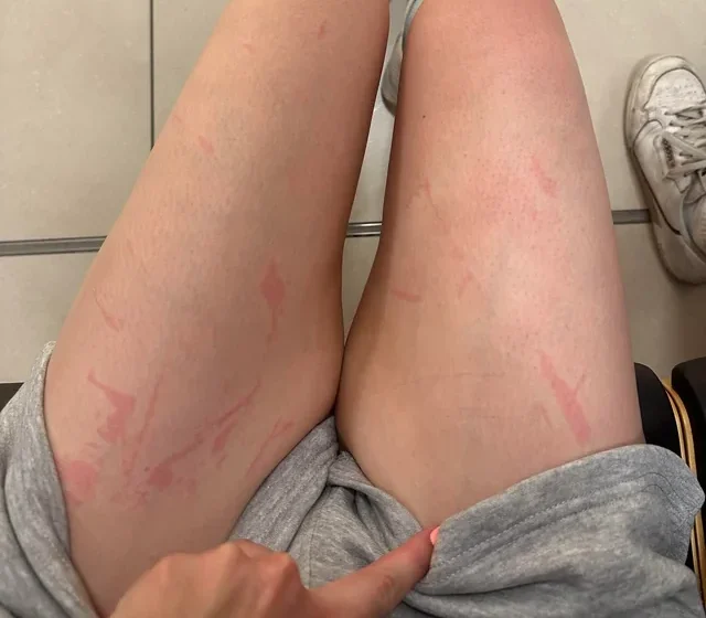 Réaction de la peau sur la jambe après une épilation à la cire chaude, irritation cutanée, rougeur, peau arrachée, brûlure légère, lésion après épilation, réaction allergique possible, sensibilité cutanée, soins de la peau après épilation, erreur d’épilation à la cire.